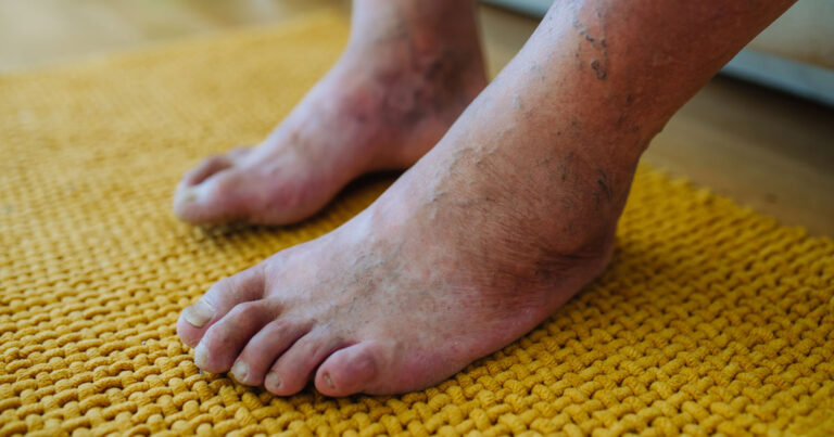 Diabetic Foot Ulcers treatment