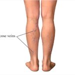 Varicose veins treatment