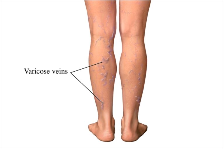 Varicose veins treatment